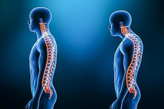 Can you prevent the hunched back of kyphosis? featured image