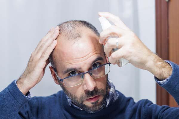 A prematurely bald man sprays a hair regrowth product on his hair and scalp.