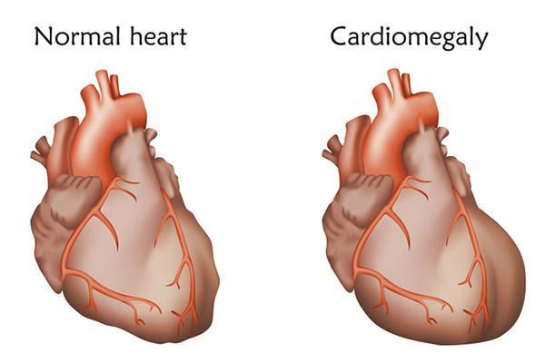 Illustration showing a normal heart on the left and an enlarged heart (cardiomegaly) on the right.