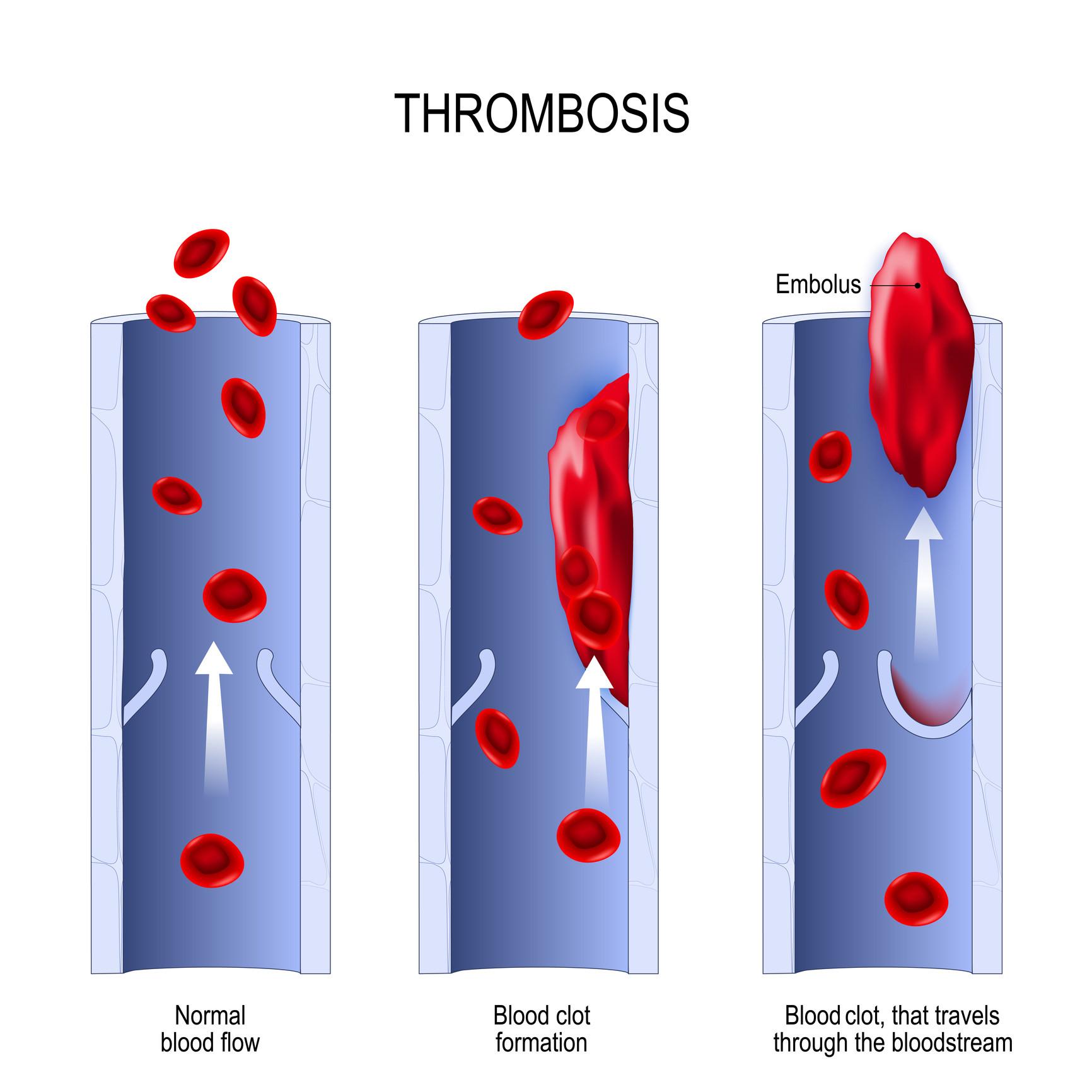 thrombosis. From Normal blood flow to Blood clot formation, and clot, that travels through the bloodstream