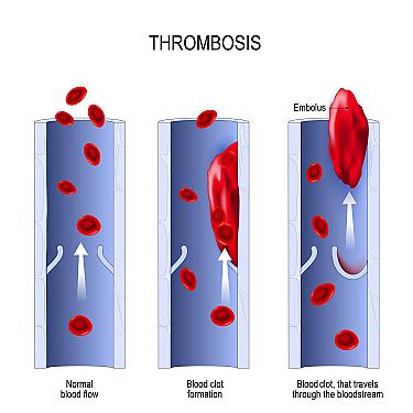 Leg clots (aka deep-vein thrombosis): an immediate and long-term health hazard featured image