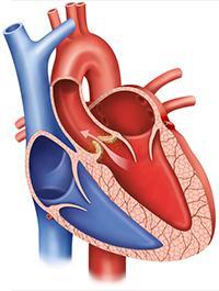 Illustration of a heart showing aortic valve stenosis, a condition in which the aortic valve narrows, impeding blood flow from the heart's left ventricle to the main artery.