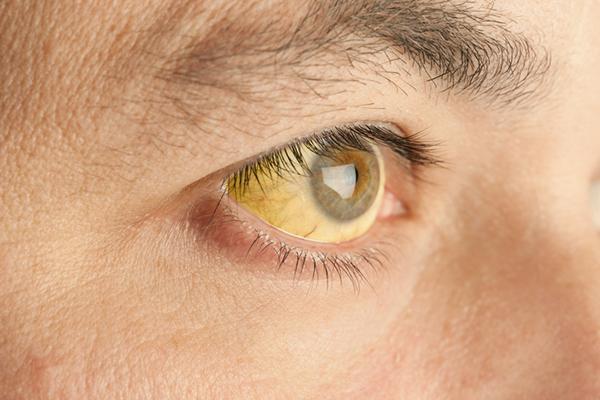 Close-up of the eye of a person who has jaundice; the white of the eye has turned yellow.