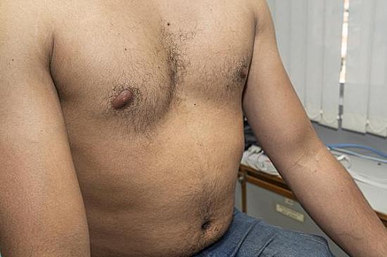 Does pectus excavatum increase my risk of lung or heart problems in midlife? featured image