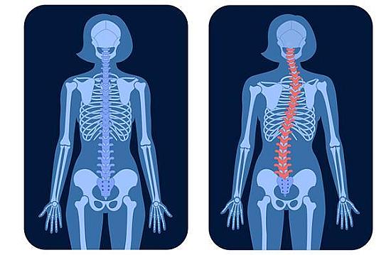 Scoliosis treatment: Can it help as you get older? featured image