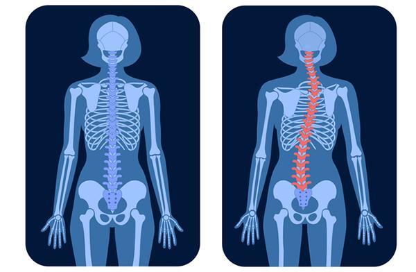Side-by-side illustrations of anatomy showing the skeleton of a person with a normal spine and a person with scoliosis, with the curved spine highlighted in red.