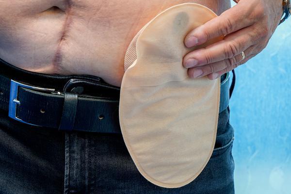 Close-up of the midsection of a man with a scar descending from his navel, with his hand on a colostomy bag.