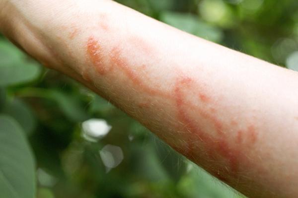 Close-up of poison ivy rash on a person's arm showing raised red skin blisters.