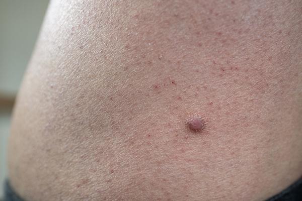 Close-up of a dermatofibroma on a person's leg.