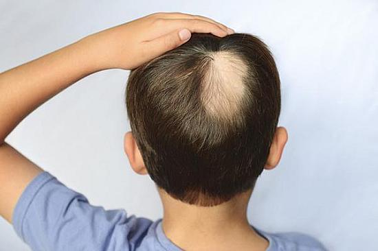 What could cause hair loss in a preteen boy? featured image