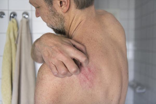 What is neurodermatitis and how is it treated?