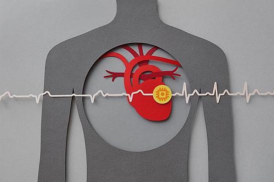 What is third-degree heart block? featured image