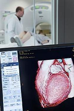 Atherosclerosis: Can AI help your doctor detect it? featured image