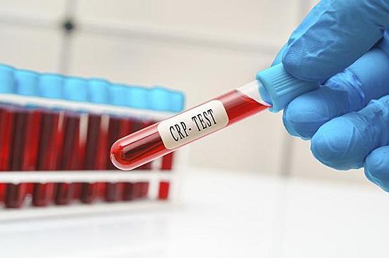 C-reactive protein: Should healthy people be tested for it? featured image