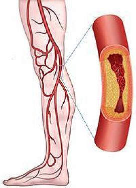 Treating peripheral artery disease: When might you need a procedure? featured image
