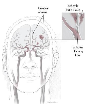 What happens during a stroke