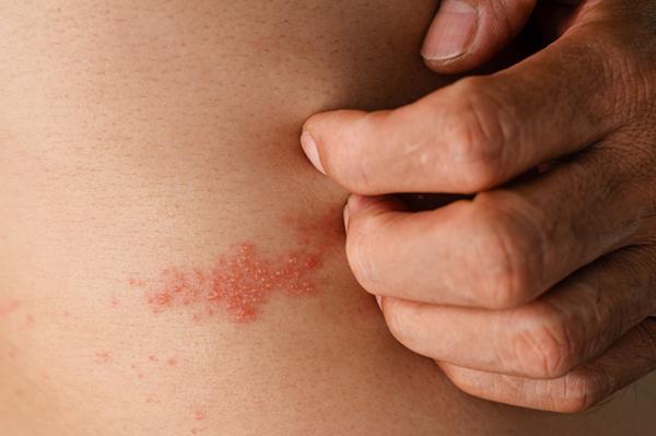Can taking Valtrex for shingles affect my birth control?