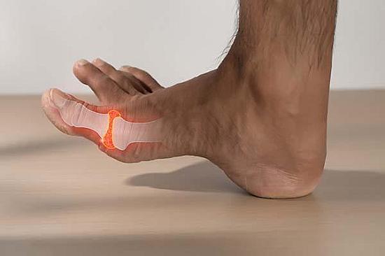 Gout and heart disease: What's the connection? featured image