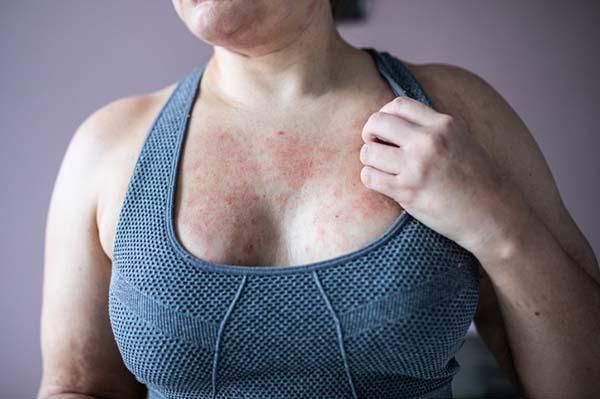 What causes painful, itchy bumps on the skin after sweating?