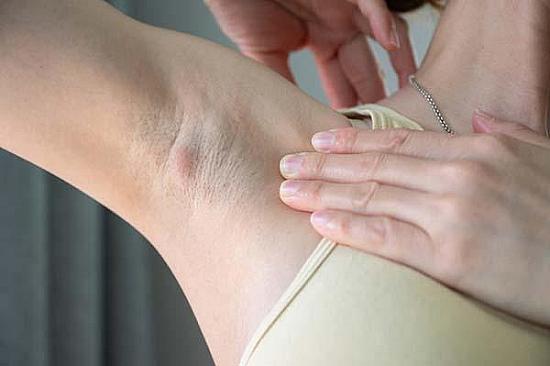What causes recurring underarm boils, and how are they treated? featured image