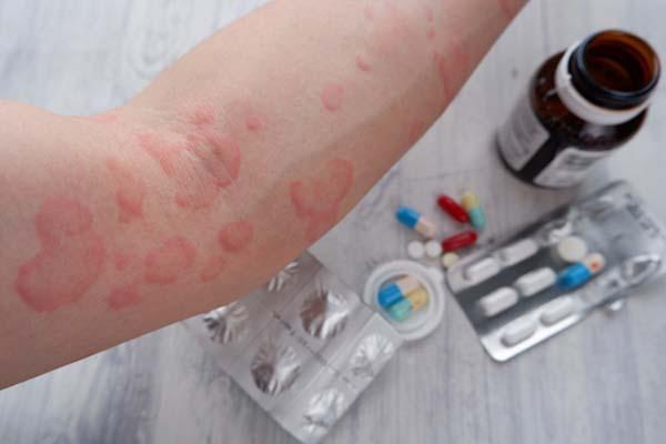 What causes chronic hives, and how are they treated?