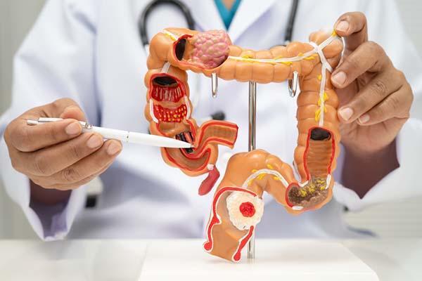 Close-up of a doctor displaying a model of the human intestine and using a pen to point to part of the colon.