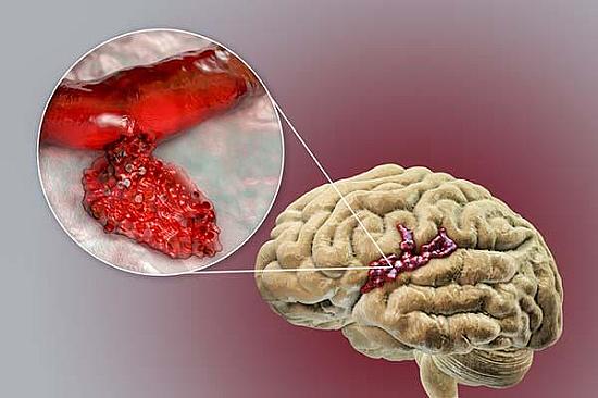 Cerebral amyloid angiopathy: A little-known cause of cognitive decline and stroke featured image