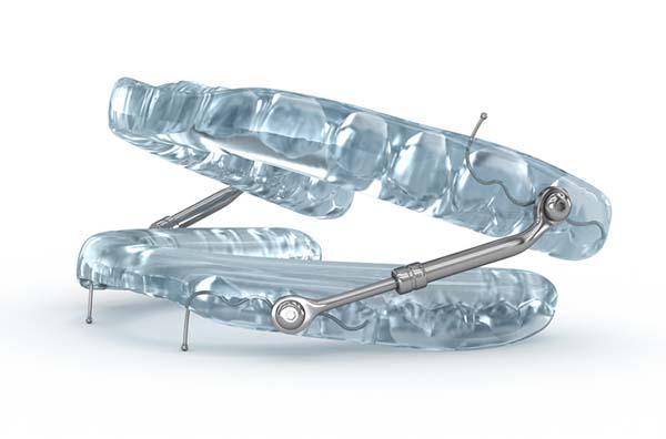 Three-dimensional illustration of a mandibular advancement device used to treat sleep apnea.