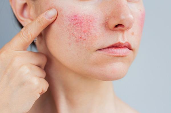 Close-up of the face of a woman with red bumps on her cheeks caused by roascea.