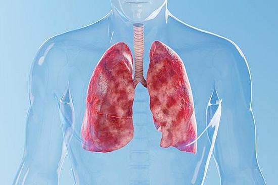 What's the difference between walking pneumonia and bronchitis? featured image
