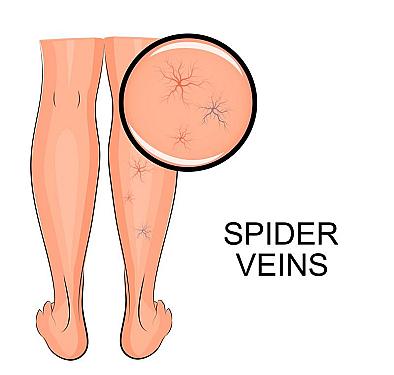 Spider veins featured image