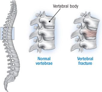 Treating Compression Fracture with Kyphoplasty vs. Bracing