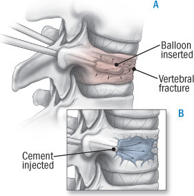 Cheltenham Spine Clinic - Osteoporotic Vertebral Compression Fractures