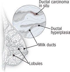 Ductal Carcinoma in Situ: Symptoms, Causes & Treatment