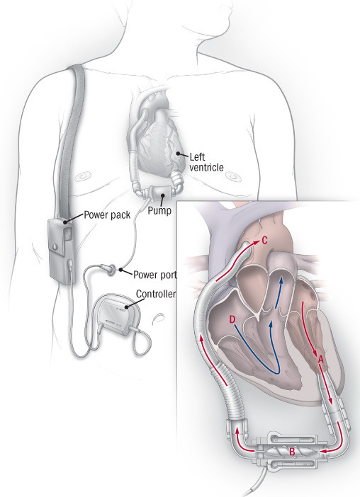 illustration of left ventricular assist device