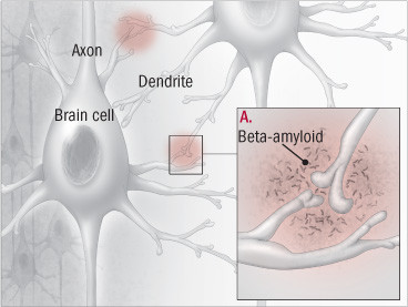 Diagnosing Alzheimer's disease