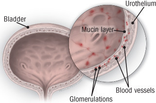 Diagnosing and treating interstitial cystitis