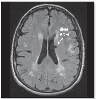 Could a silent stroke erode your memory?