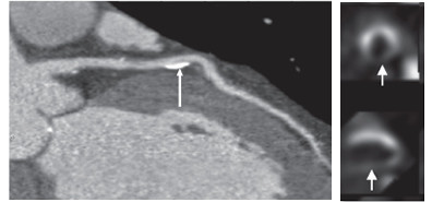 Coronary CT angiogram