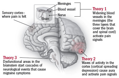 The mystery of migraines