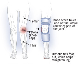 knock knees braces