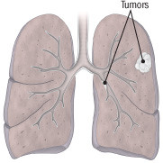 Lung cancer: Not just for smokers