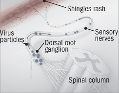 shingles-vaccine-a-containment-policy