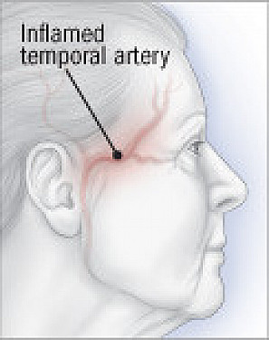 When arteries get inflamed featured image