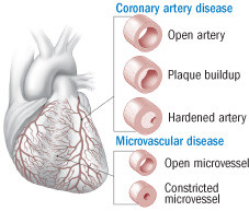 New view of heart disease in women