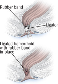 rubber-band-ligation
