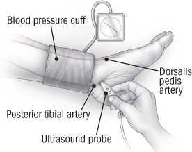 high ankle blood pressure