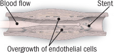 restenosis