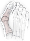 illustration of foot with bunion