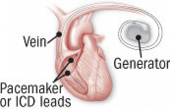 Heart Beat: Setting standards for pacemaker and ICD lead extraction featured image